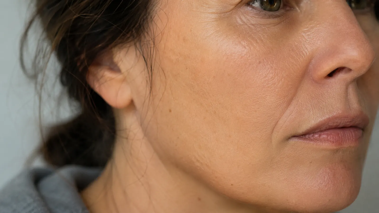 Close-up of calmer, more even-toned skin on a woman's cheek and jaw months later